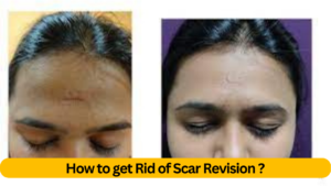 How to get Rid of Scar Revision ?