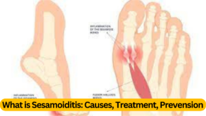 What is Sesamoiditis ? : 3 Causes, Treatment, Prevension ( Best Knowledge )