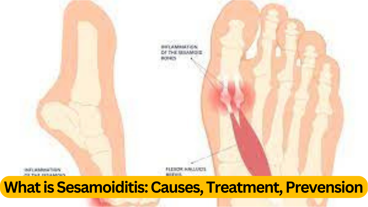 What is Sesamoiditis ? : 3 Causes, Treatment, Prevension ( Best Knowledge )